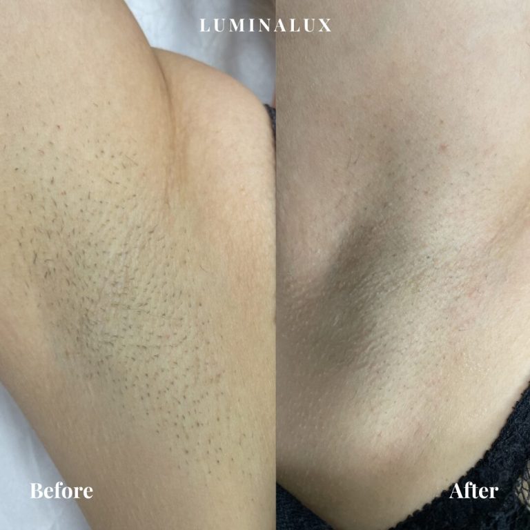 Kunden her har fået 4 behandlinger med permanent hårfjerning i armhuler