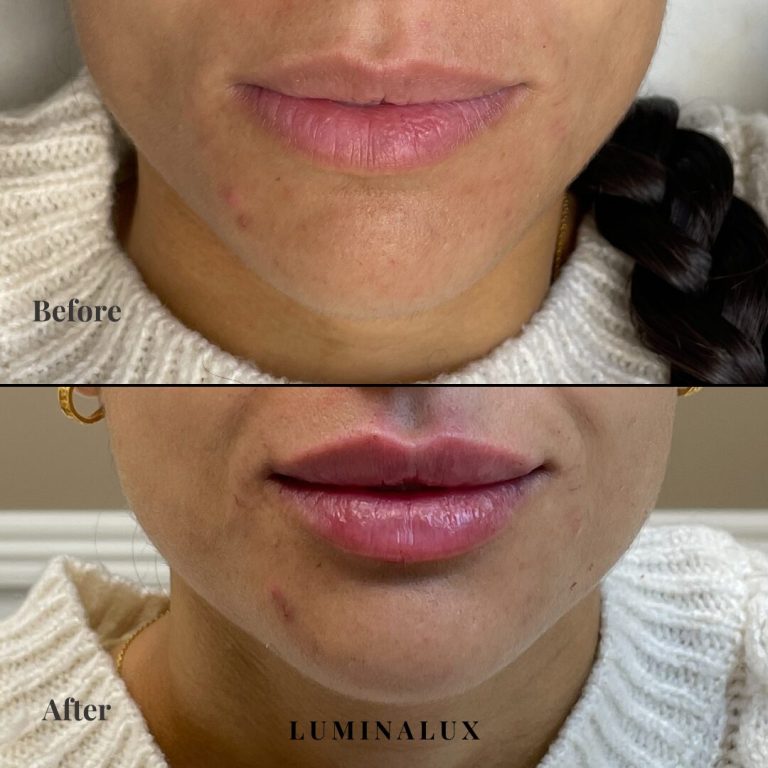 lip filler før og efter