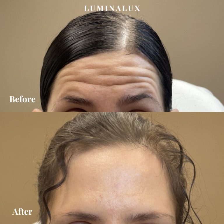 Kunden har fået behandlet dynamiske rynker i panden