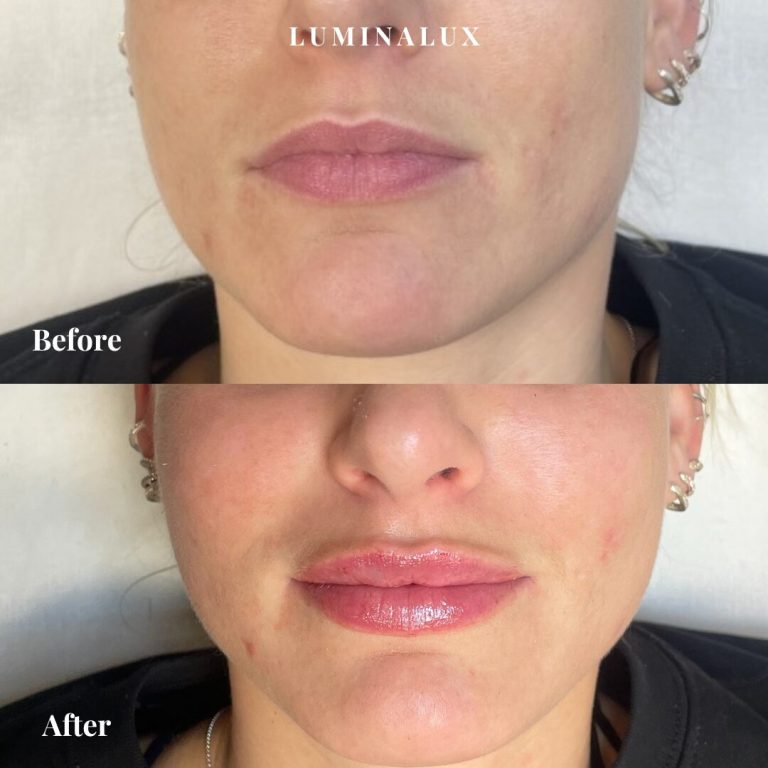 Kunden her har fået behandling med fillers i læberne med fokus på øget volumen i læberne