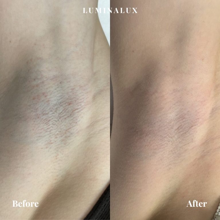 Hårfjerning i armhuler