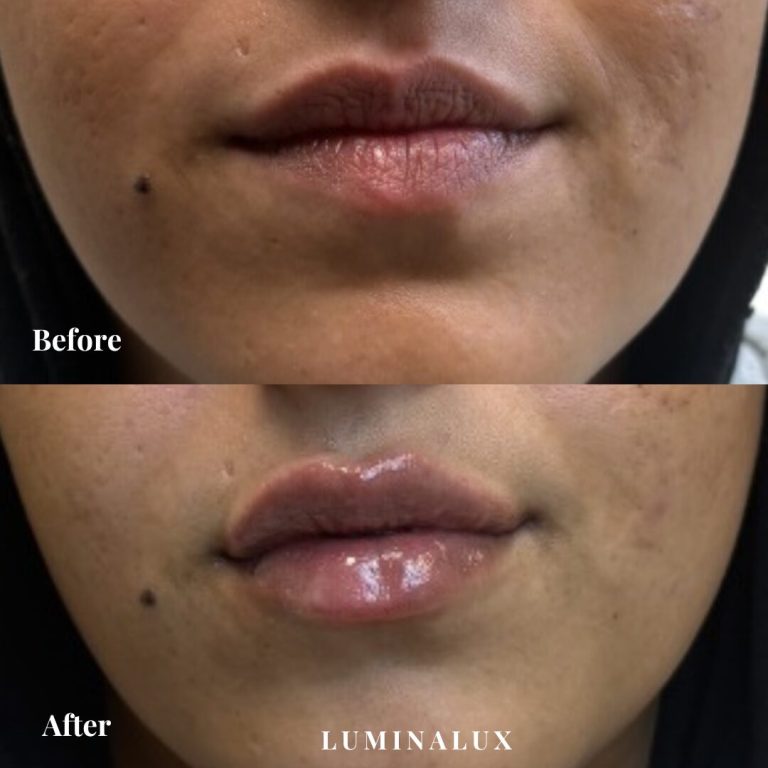 Lipfillers - fylde i læber