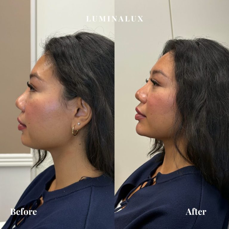 Hagekorrektion filler i hagen