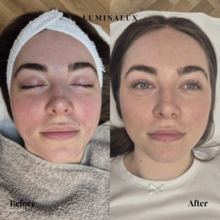 SkinPen microneedling