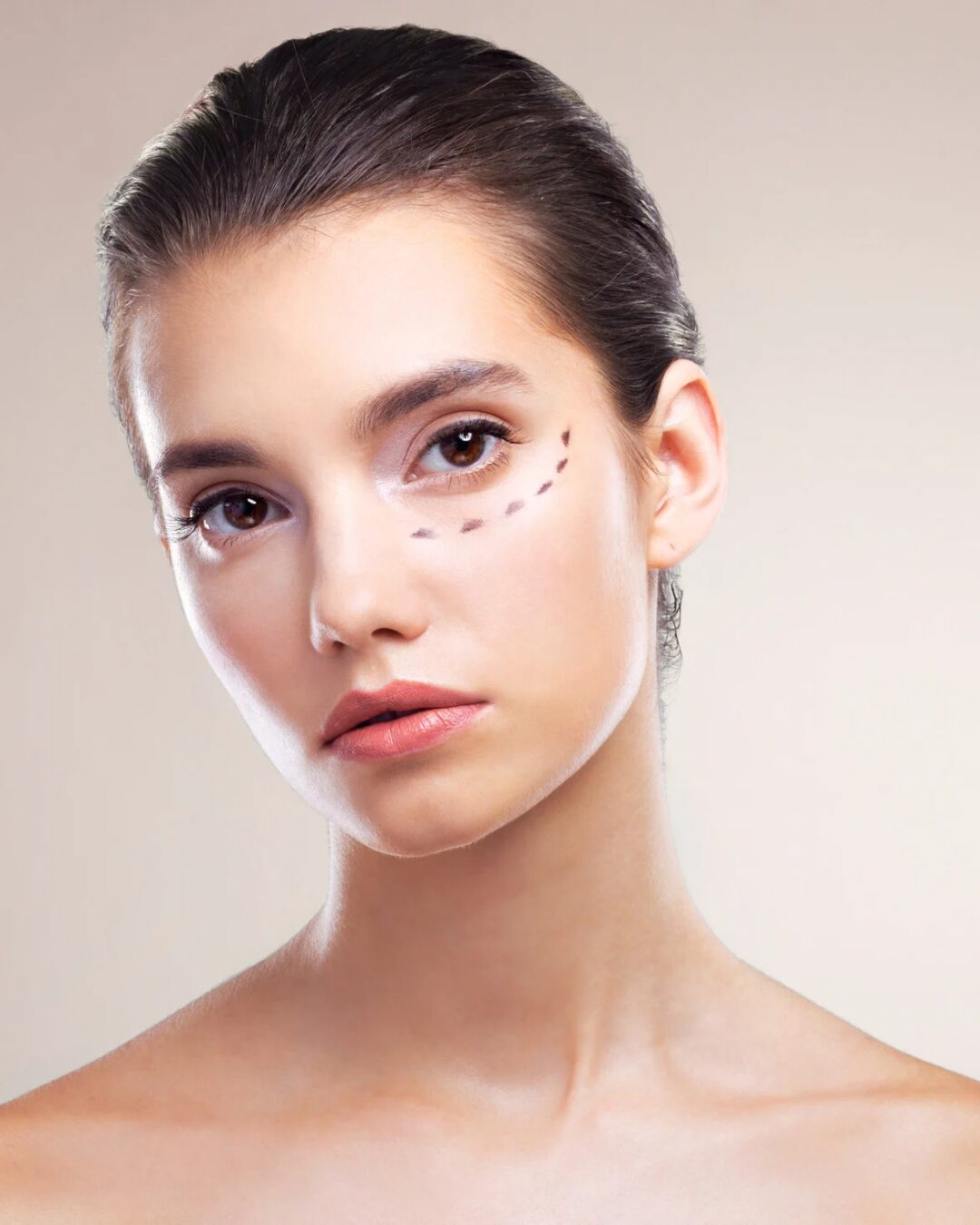 Restylane under øjnene