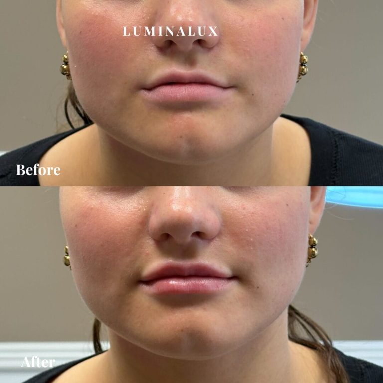 Diskret læbeforstørrelse med fokus på naturligt udseende