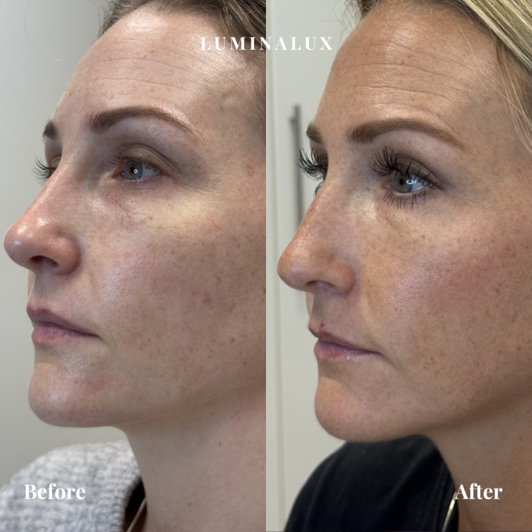 Vitaran under øjnene